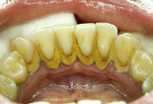 Cao răng gây ra bệnh gì?
